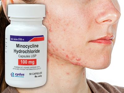 Acne and Minocycline