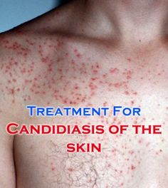 Cutaneous Candidiasis - Tips For Curing the Skin Condition