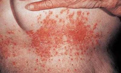 Cutaneous Candidiasis - Tips For Curing the Skin Condition
