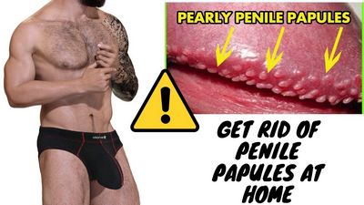 Know Your Papule - What To Do About It