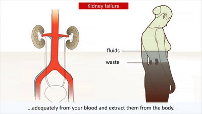 Nephropathy - Kidney Failure Caused by Nephrophy