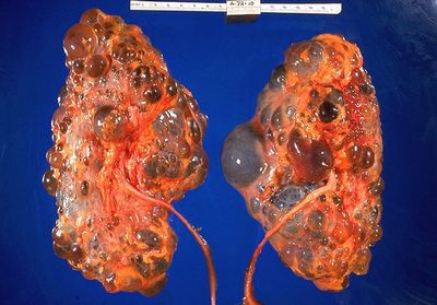 Nephropathy - Kidney Failure Caused by Nephrophy