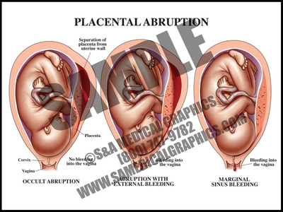 Placental Abrasion