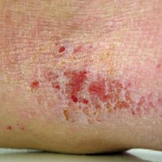 Skin Rashes And The Five Most Common Causes