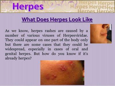 What Does A Herpes Symptom Looks Like?