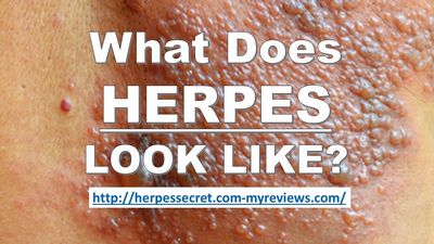 What Does A Herpes Symptom Looks Like?