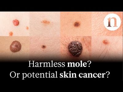 What Does Skin Cancer Look Like? Learn What to Watch For