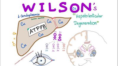 What is Wilson's Disease and How it Can Affect Your Liver